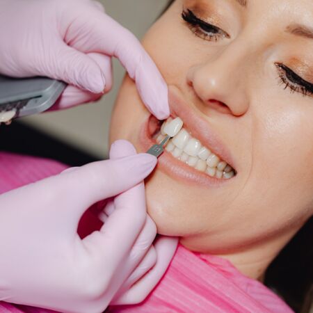 Mit Veneers von Ihrem Zahnarzt in Frankfurt-Riedberg lassen sich kleinere Makel an den Zähnen gut kaschieren.