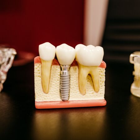 Nach dem Einsatz eines Zahnimplantats kann die Einheilung durch bestimmte Handlungsweisen untersützt werden.